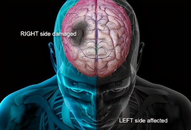 55岁血脂不高能吃他汀预防,57岁的人血脂高要不要吃他汀