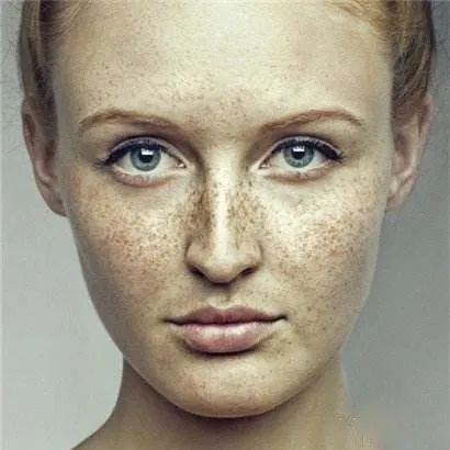 武汉第一医院皮肤科祛斑医生推荐,权威皮肤科专家谈祛斑