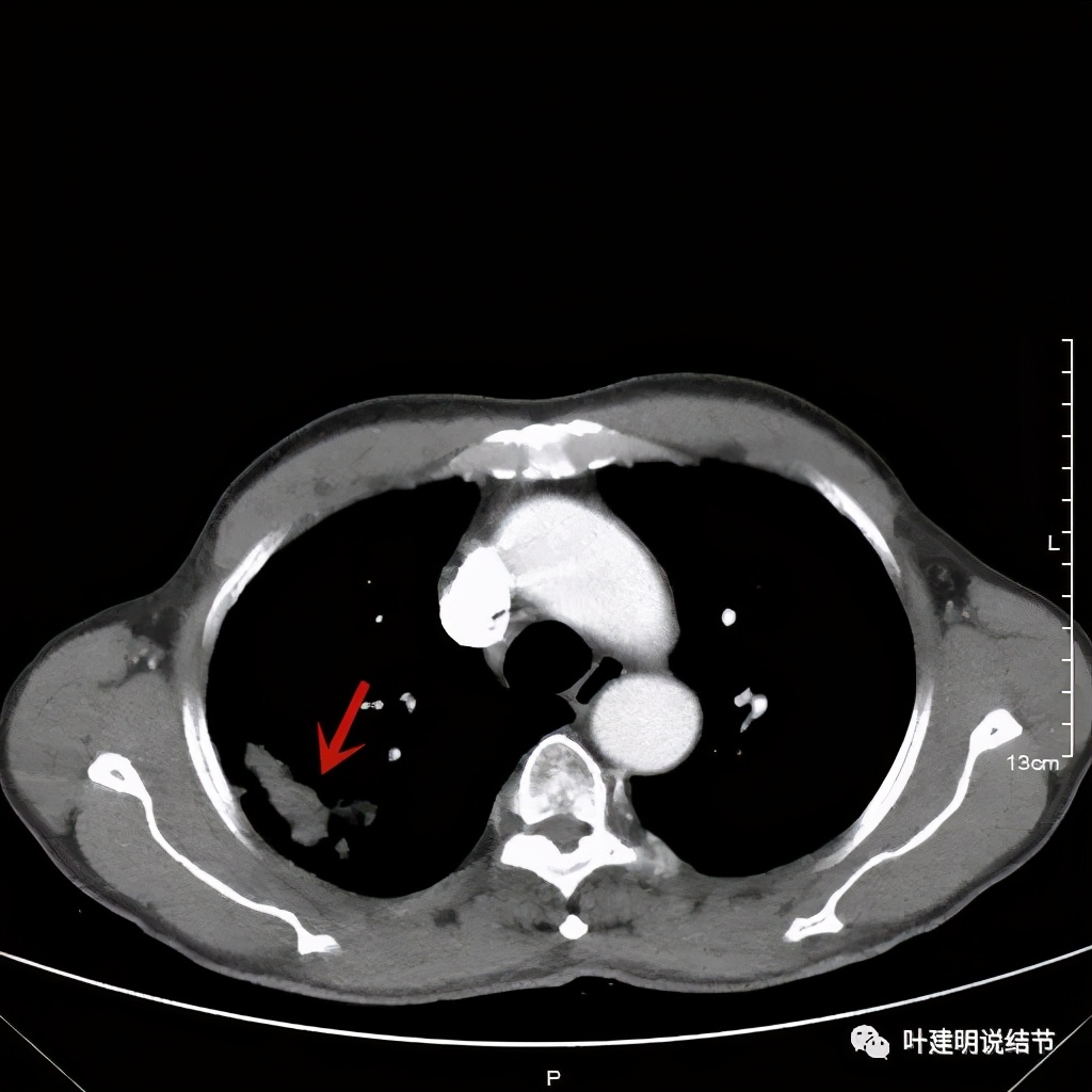 肺占位病理活检无病变,肺部占位穿刺病理说不确定性质