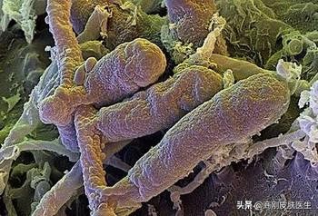 体癣衣物怎么消毒,体癣反复发作怎么回事