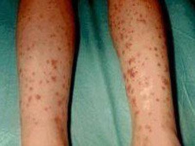 腹型过敏性紫癜治好了注意什么,过敏性紫癜饮食上要注意些什么