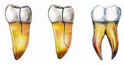 大牙咬裂了是否一定要拔,牙齿咬裂了必须拔牙吗