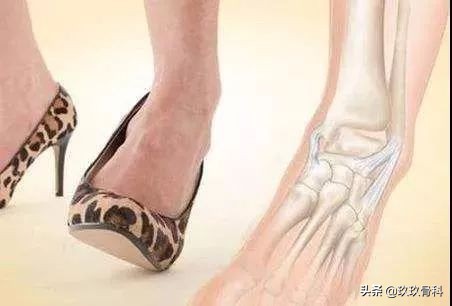 脚踝扭伤一个月后康复训练法,脚踝扭伤是否需要康复训练