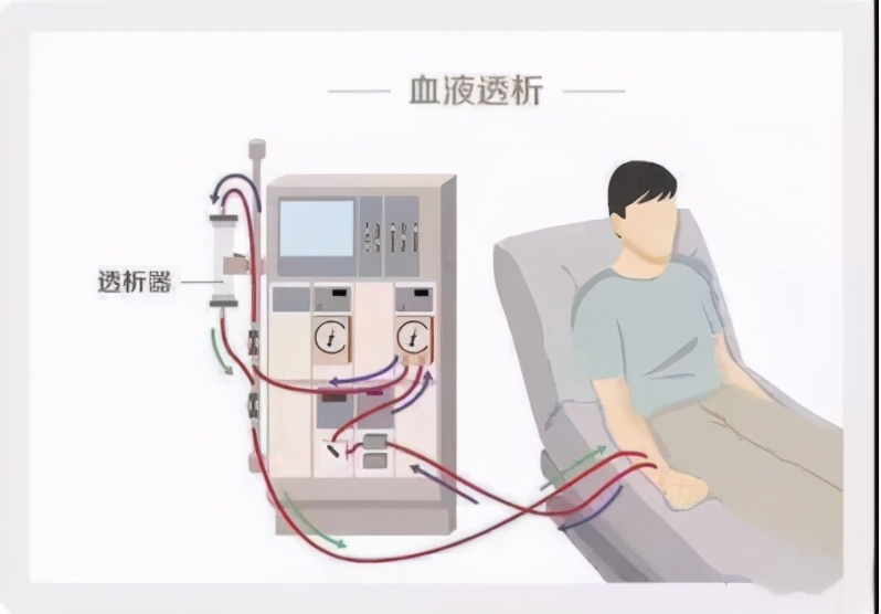 血透患者感染了新冠病毒怎么办,血液透析病人染上新冠病毒怎么办