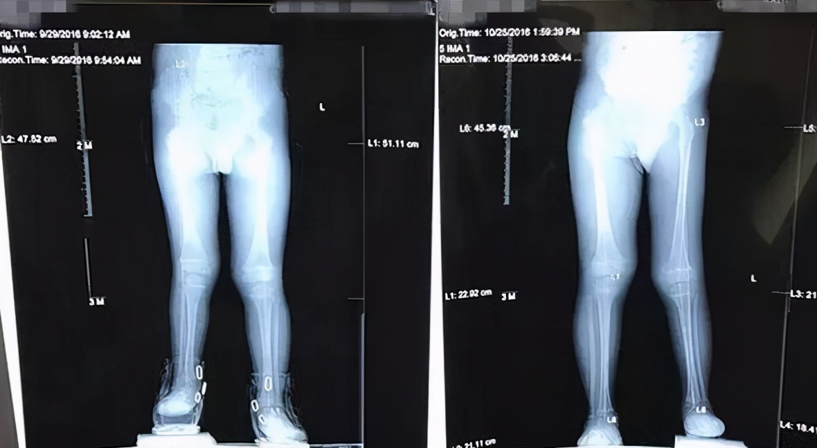 儿童左右腿骨骼发育不一致,2岁男童走路好像腿软总是摔倒