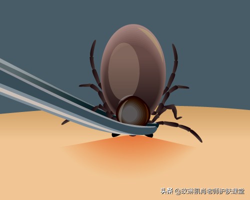 螨虫感染皮肤的症状如何去除,全身被螨虫咬怎么解决