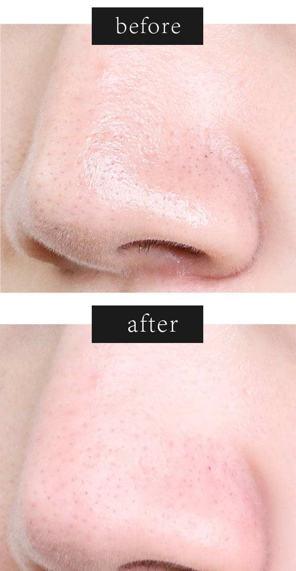 inface黑头仪好用吗,拒绝油腻大叔