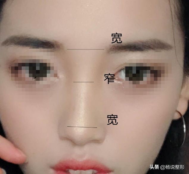 六种常见的失败隆鼻手术,隆鼻怎么预防鼻头越来越尖