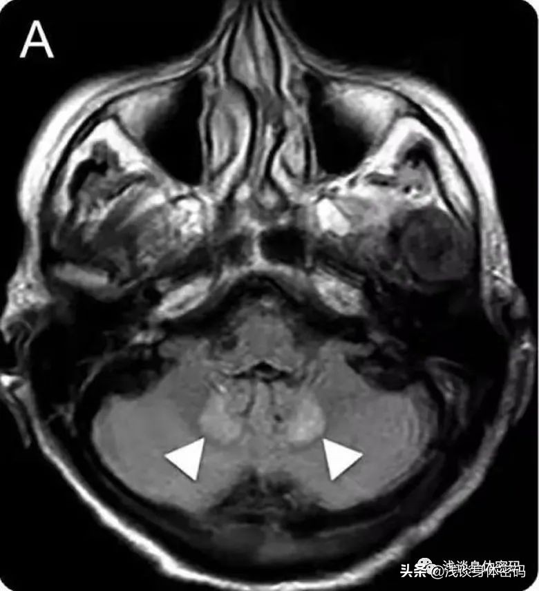 甲硝唑中毒可逆吗,甲硝唑中毒性脑病ct表现