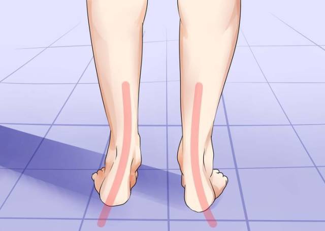 跑步时脚是外八字怎么纠正,膝盖内扣脚外八字跑步