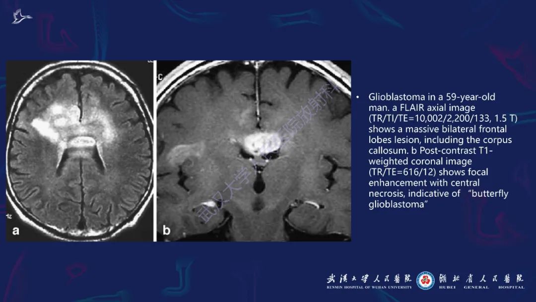 胼胝体肿瘤影像鉴别,胼胝体病变影像诊断