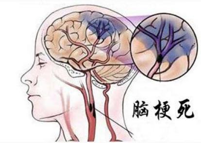 脑梗死中医诊断及辨证,滨州中医院治疗脑梗怎么样