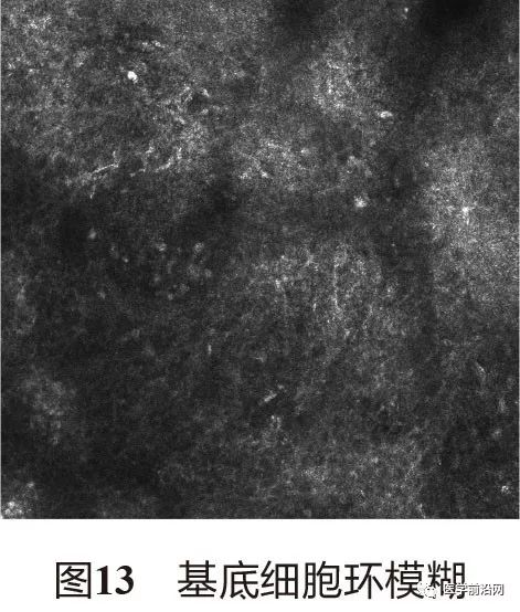 炎症性皮肤病反射式共聚焦显微镜诊断特征专家共识全文发布