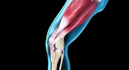 半月板虽然三度损伤但不影响走路,半月板损伤好了膝盖还是有点不直