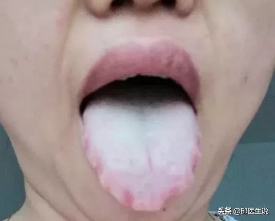 解决身体的湿气的偏方,本人湿气较重怎么能快速除湿气