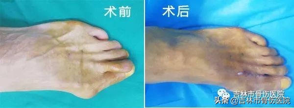 大脚骨对女性的危害很大,大脚骨的危害图片