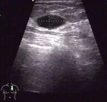 乳房里有水泡是囊肿吗,乳腺增生乳房有囊肿怎么治疗