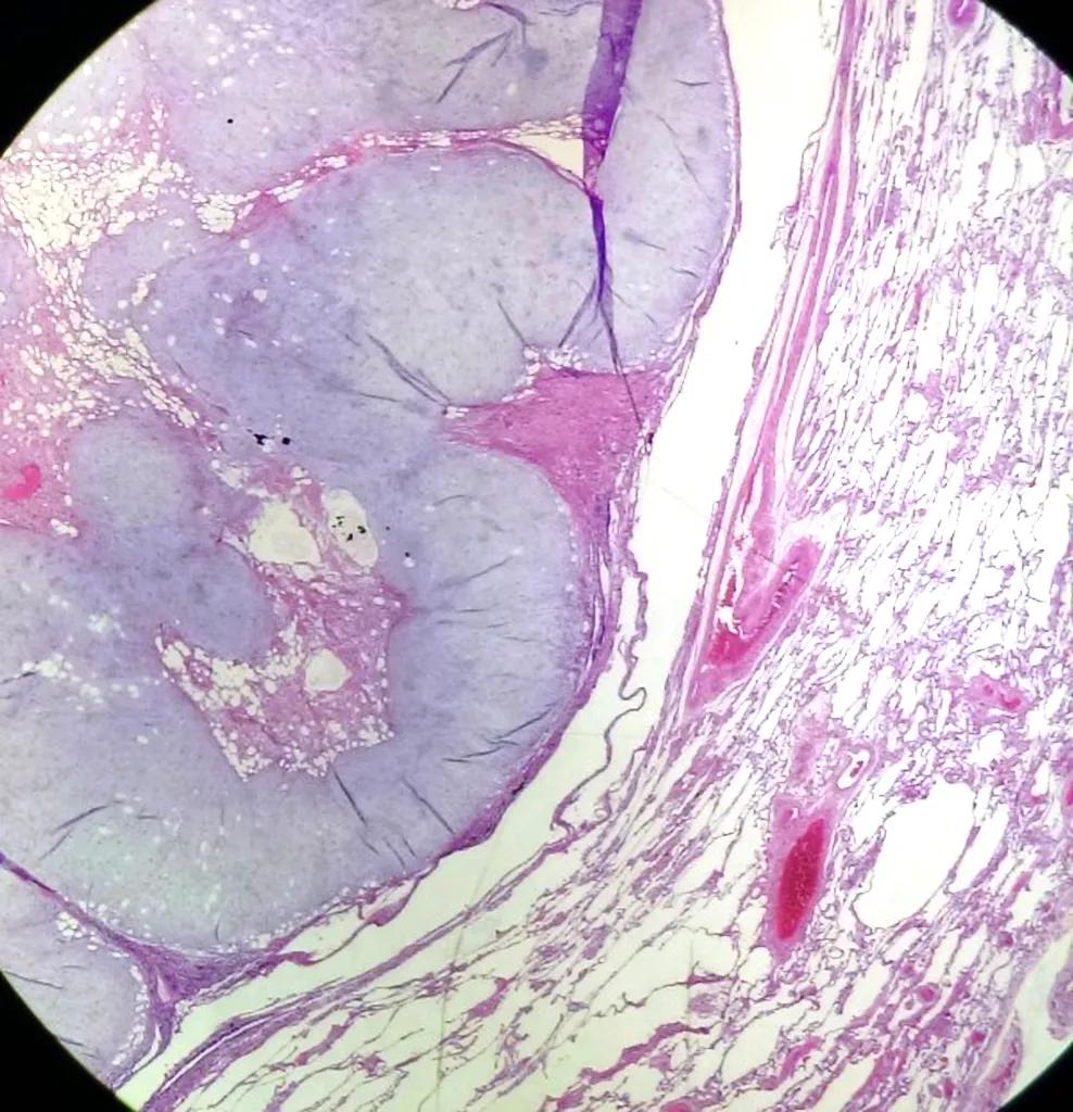 肺内见多发小囊状无纹理透光影,肺内肿块并厚壁空洞