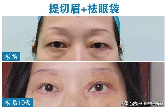双眼皮全切加祛眼袋后1-7天恢复图,做完提眉去眼袋手术流泪