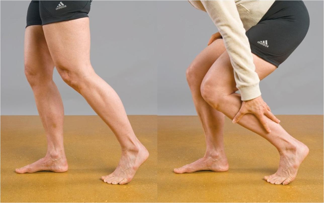 膝关节结核，是由结核杆菌引起的，主要临床表现是单侧关节发病