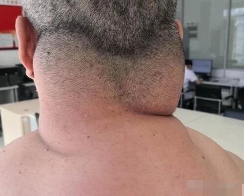 辽宁大叔喝酒40年后续,喝酒三十年喝出河马脖