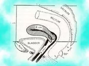 医学科普便秘篇之--直肠前突