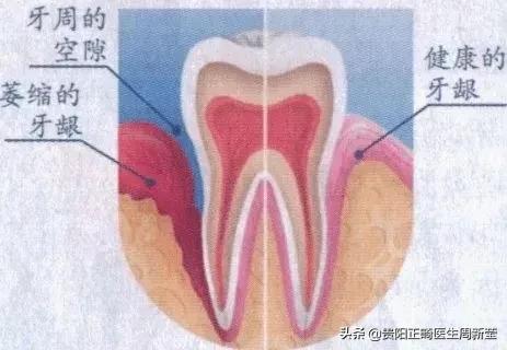 冷光美牙仪的危害,朋友圈冷光美牙仪