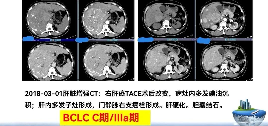 肝癌晚期靶向治疗怎么做,中国肝癌tace治疗展望