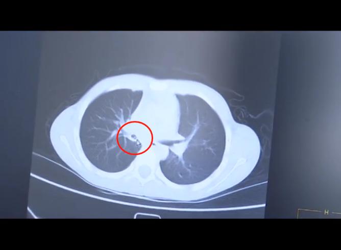 11岁男孩反复发烧退不下去怎么办,14岁男孩反复发烧去医院检查