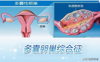 多囊卵巢综合征可以如何诊断出来呢？