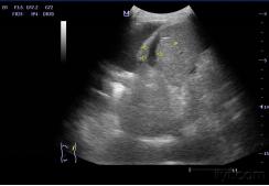 怎么排除脾脏破裂,如何能造成脾脏破裂