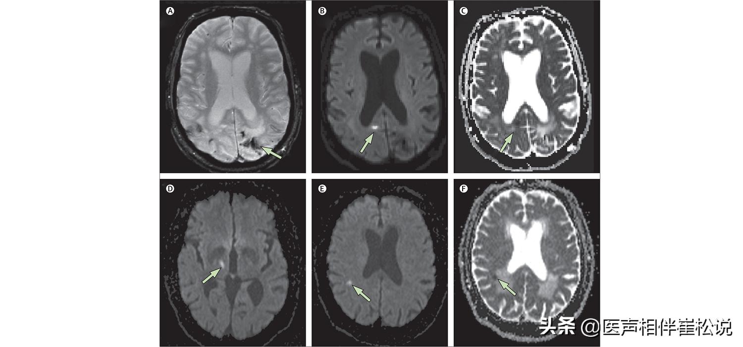脑梗腔梗应该挂号什么科,腔梗和脑梗有什么区别