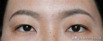 内双怎么变双眼皮整形手术多少钱,内双双眼皮适合哪种手术