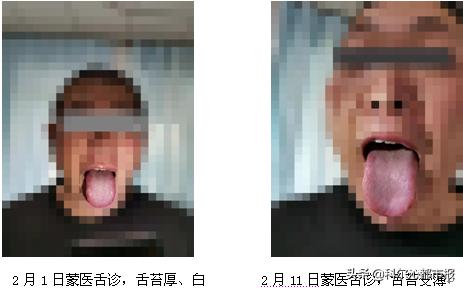 又一例蒙西医结合治愈的新冠肺炎患者出院‖蒙医药防治新冠肺炎优势体现在哪儿