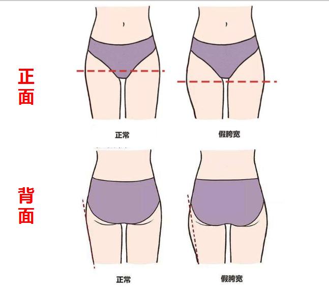 腿粗假胯宽怎么改善,修复骨盆和假胯宽的最有效方法