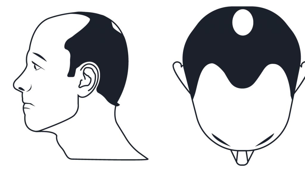 中年男性脱发原因及治疗方法,中年男性遗传性脱发能治好吗