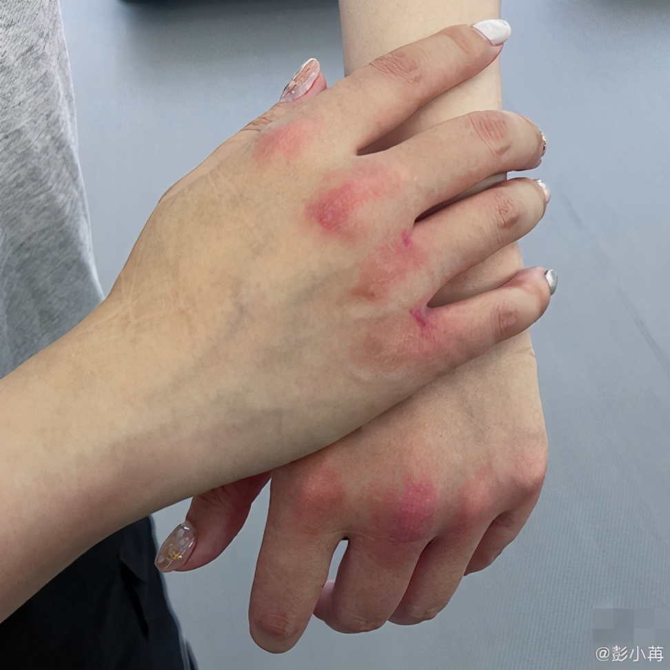 太心疼!30岁女星为减肥练拳击,双手受伤破皮,淤青严重恐留疤