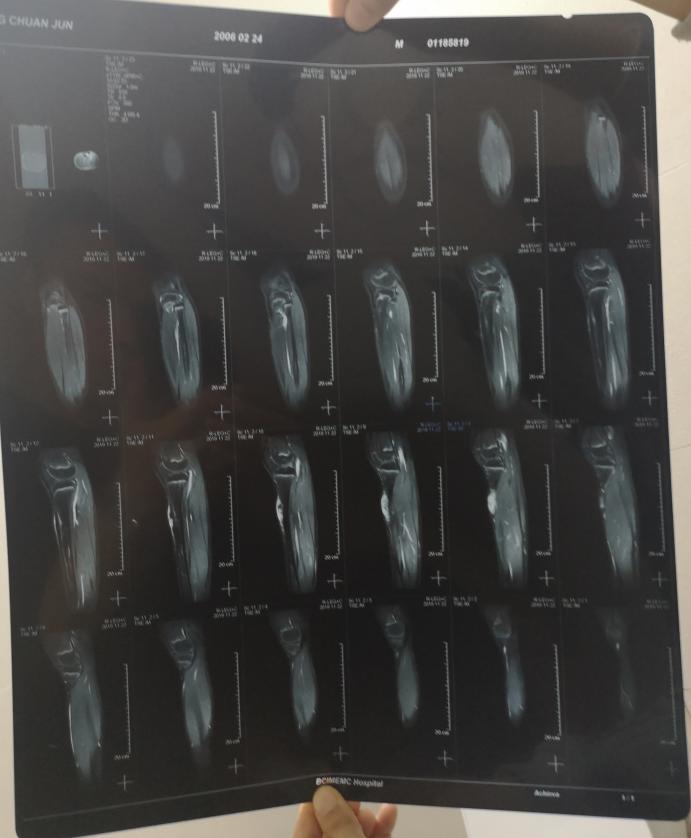 骨肉瘤复发截肢和保肢哪个复发高,骨肉瘤保肢比截肢复发率高多少