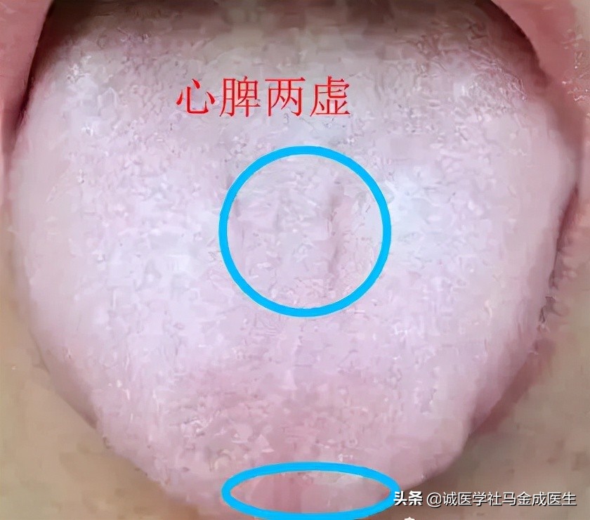 脾虚齿痕舌整天乏困吃什么中成药,治疗脾虚齿痕舌最好的中成药