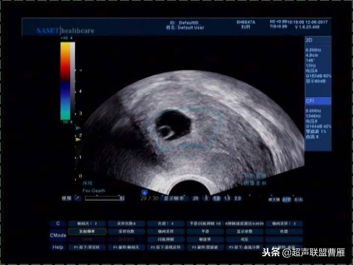 3毫米卵黄囊未见胎芽正常么,40多天的卵黄囊