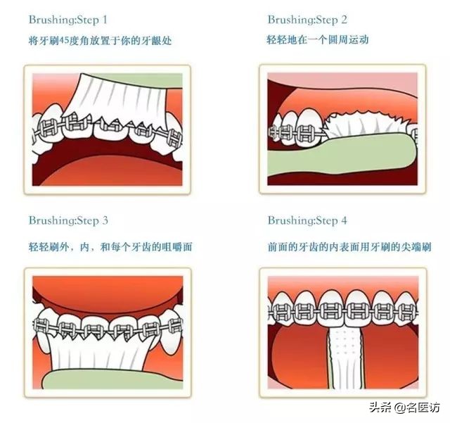 牙齿矫正保持器注意事项,衡阳牙齿矫正后注意什么