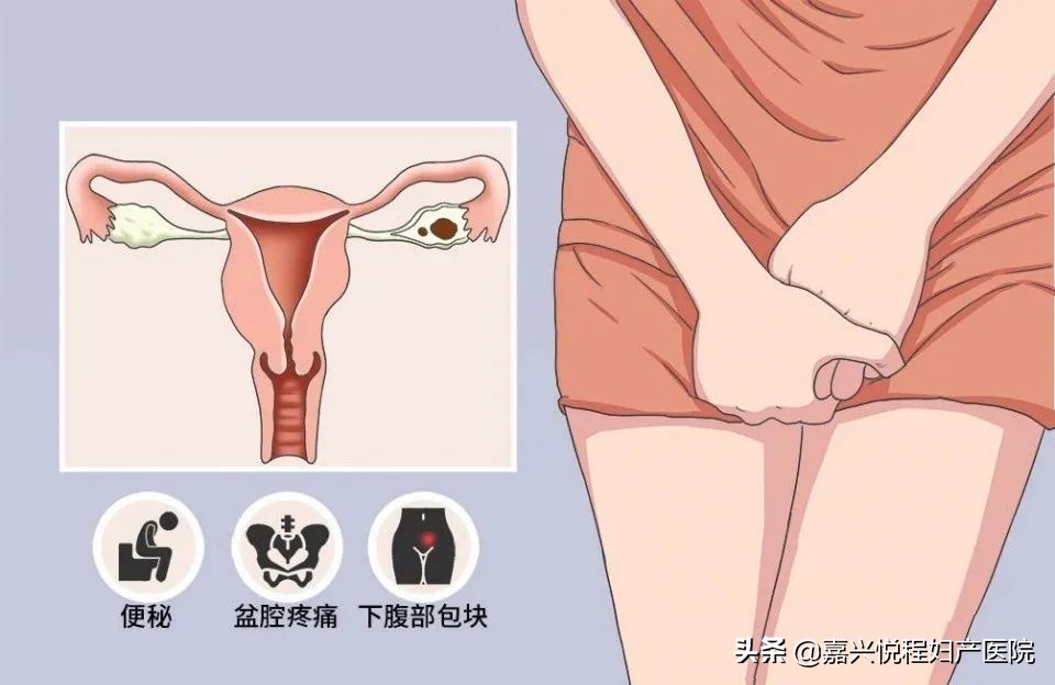 治疗慢性盆腔炎最新特效药,慢性盆腔炎用什么手术能彻底根除