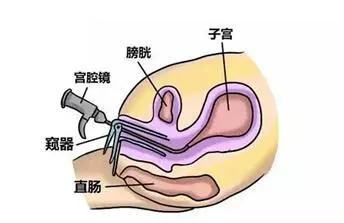 三维超声对宫腔粘连评估的重要性