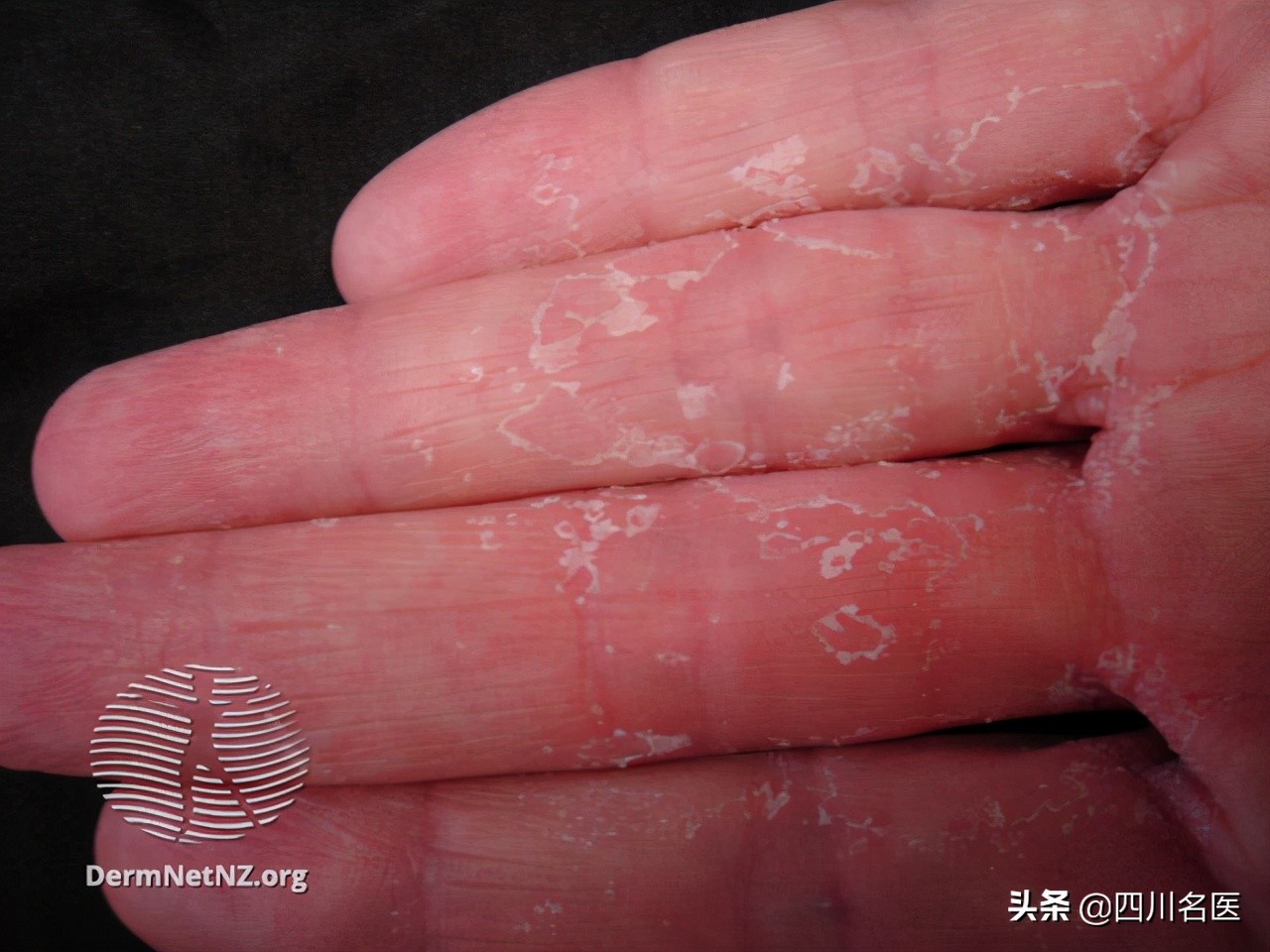 你的手指上为什么会脱皮,您的手为什么会脱皮