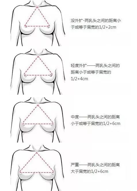 胸部外扩慌得一批？get这几招让它改斜归正