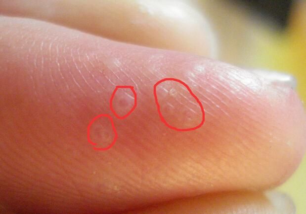 汗疱疹反反复复怎么治疗,汗疱疹反复发作怎么弄