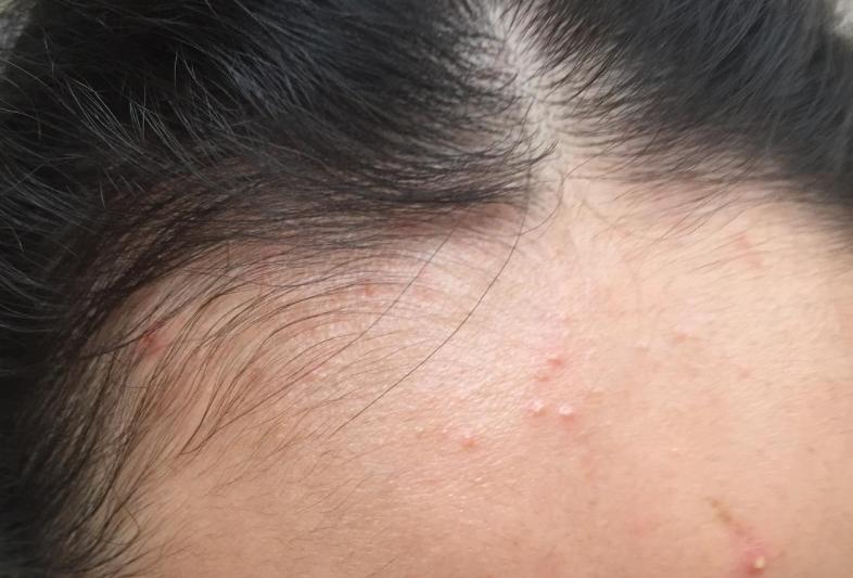 脸上长痘的几种原因,脸上长痘的三种原因