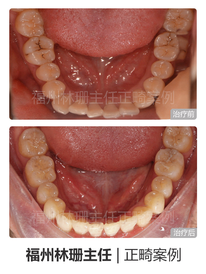 福州晋安哪里矫正牙齿,福州牙齿畸形龅牙矫正