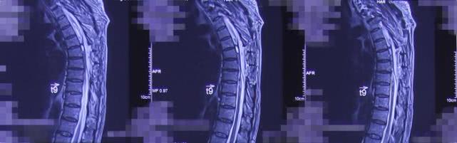 椎管内肿瘤跟椎管肿瘤一样吗,椎管内肿瘤是癌吗