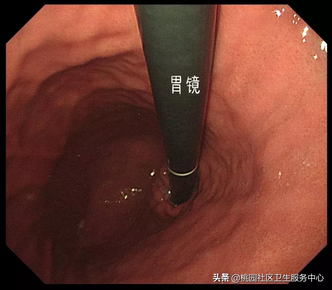 手把手教你：3分钟看懂胃镜报告